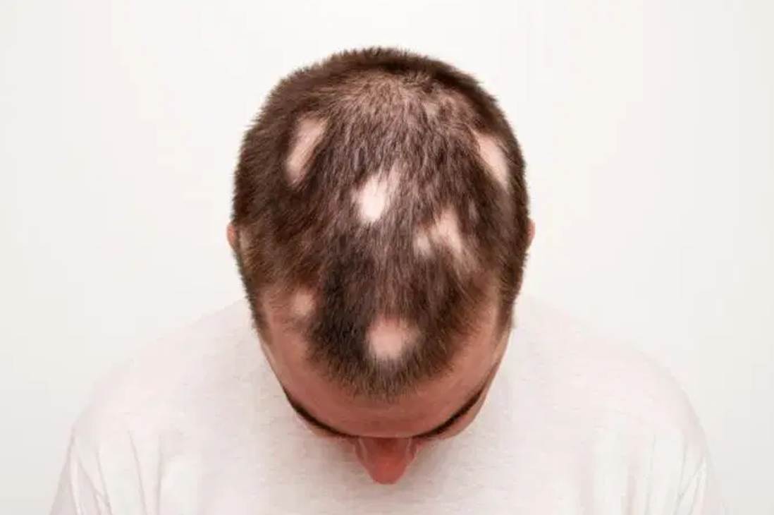 Hairloss - Sage - Alopecia