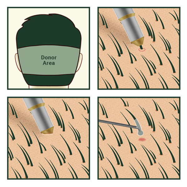 Sage Medical Hair Transplant Procedure