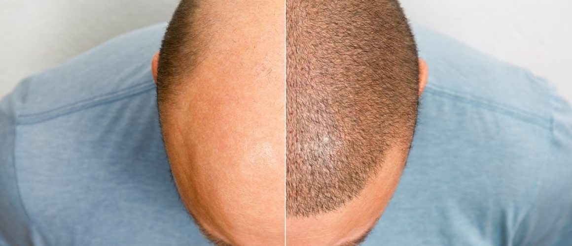 The,Head,Of,A,Balding,Man,Before,And,After,Hair