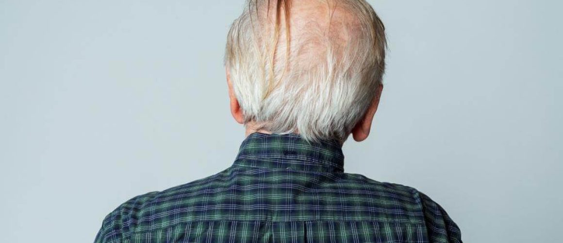 Crowning Glory: 101 on Crown Hair Transplant