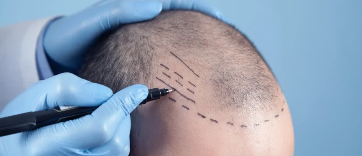 Unveiling the Truth Hair Transplant Myths Busted
