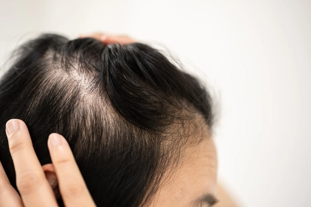 Differentiating Stress-Related Hair Loss from Other Types
