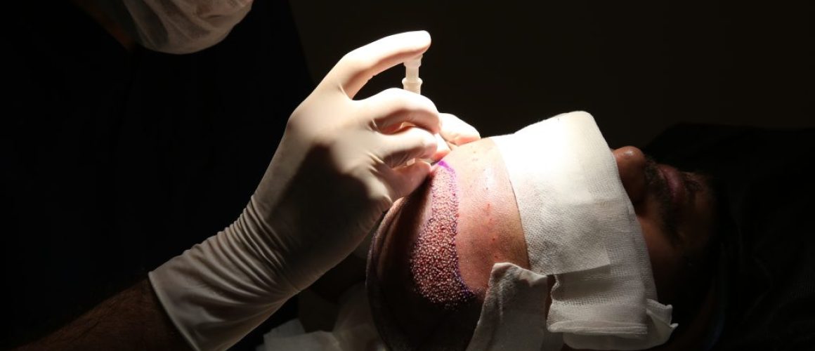 Does FUE Hair Transplants Have Any Side Effects? A Guide to Recovery