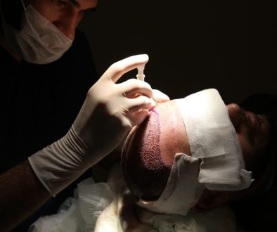 Does FUE Hair Transplants Have Any Side Effects? A Guide to Recovery