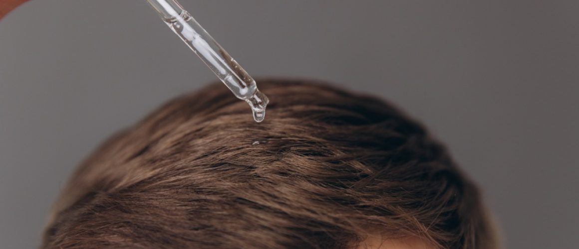 Maximising Your Results: Is Using Minoxidil After a Hair Transplant Necessary?
